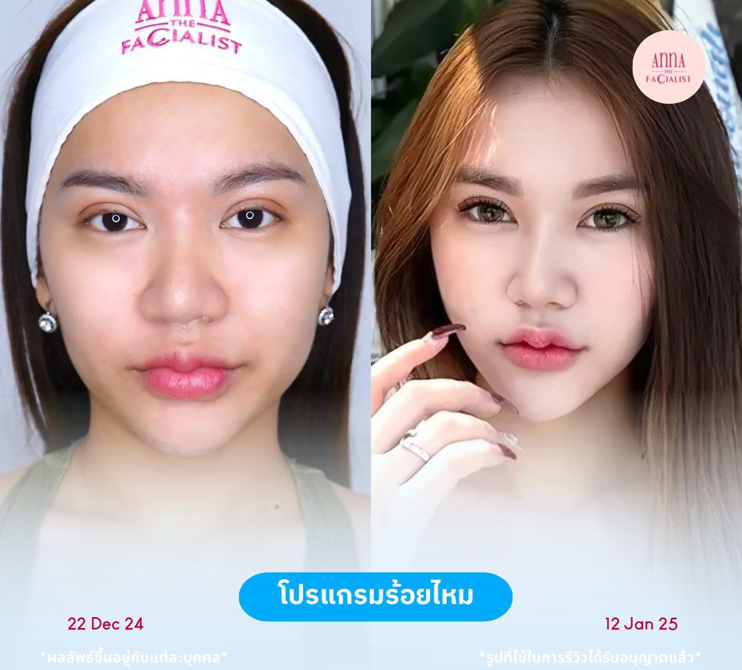 ร้อยไหม 2