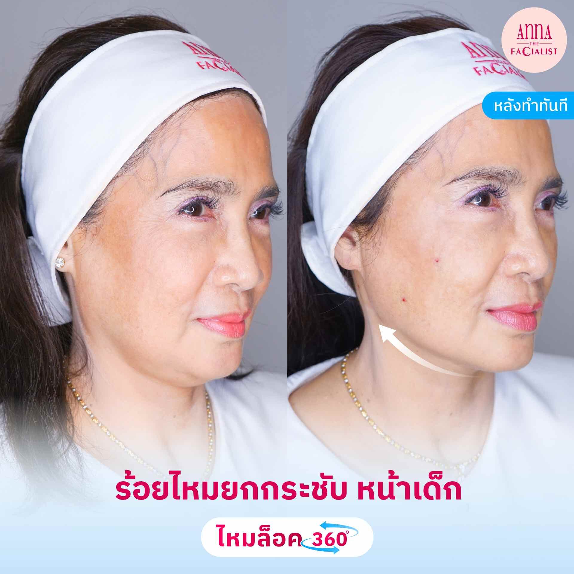 ร้อยไหม 5