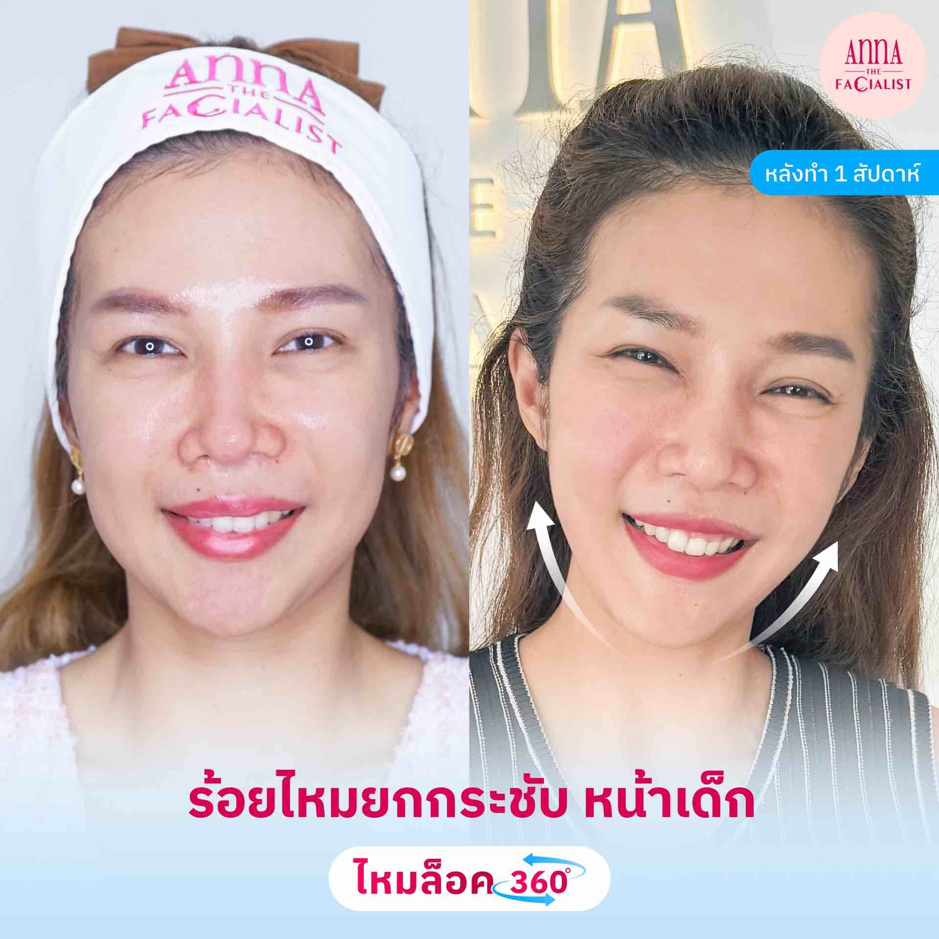 ร้อยไหม 9