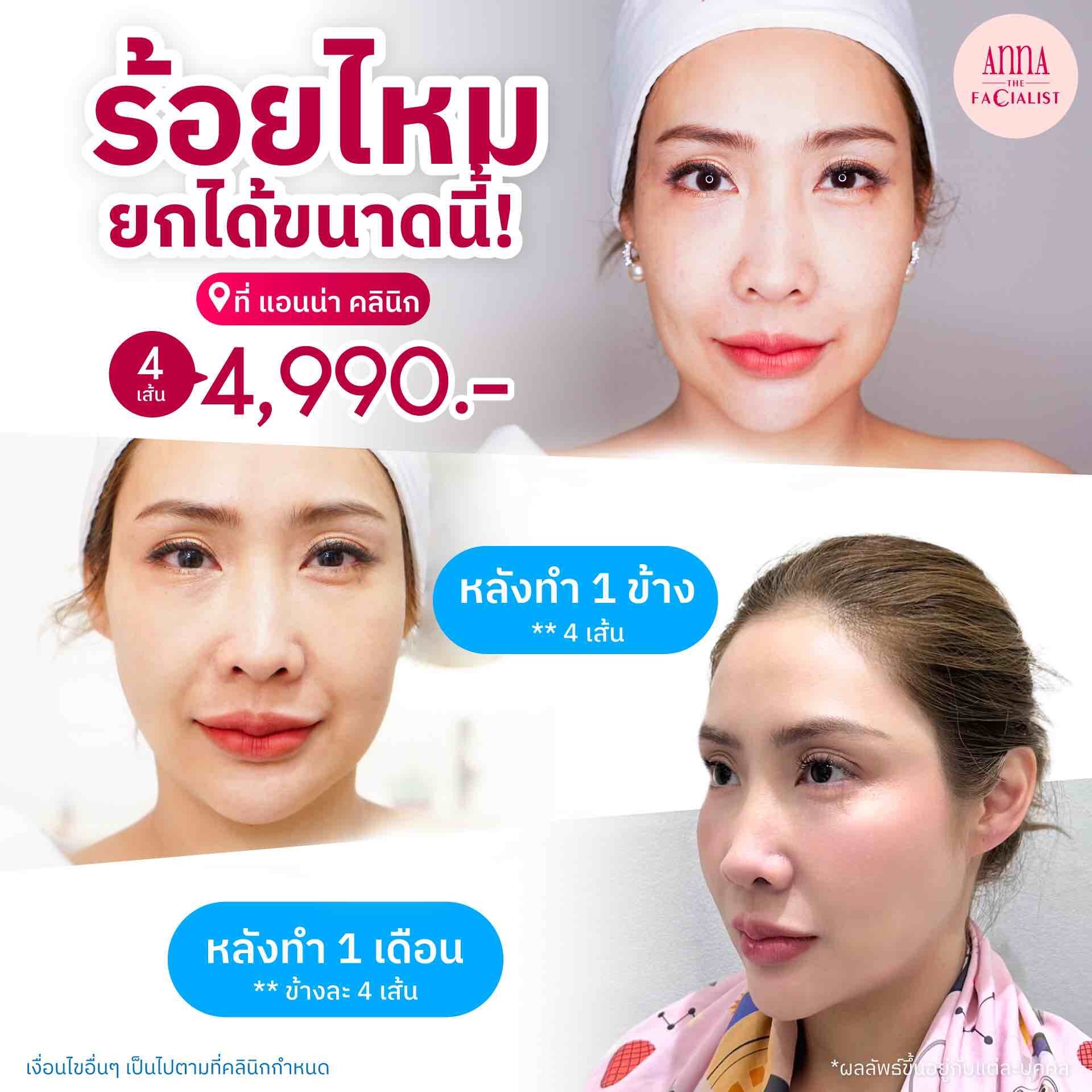 ยกได้ขนาดนี้ anna clinic