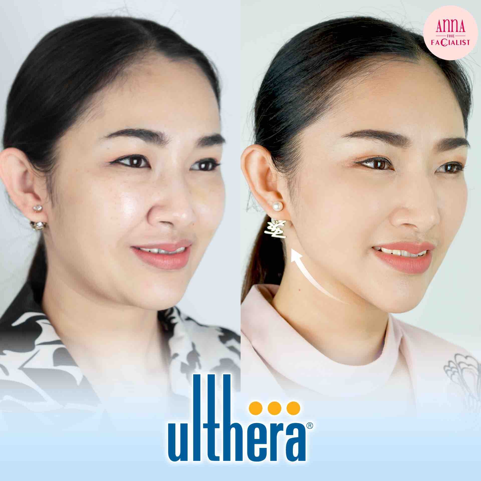 BF AT Ulthera anna clinic1