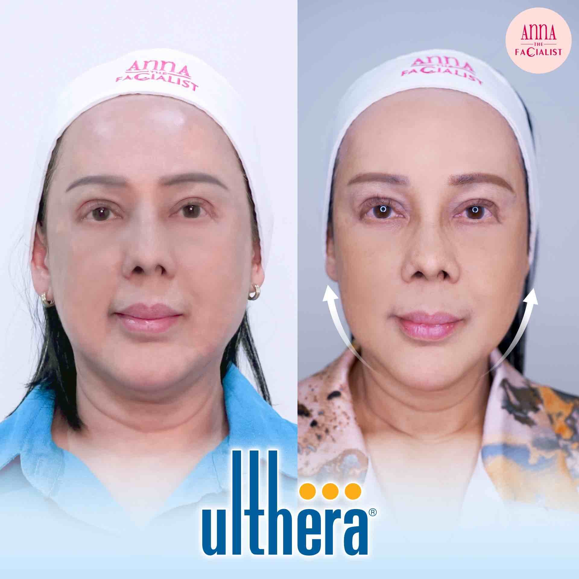 BF AT Ulthera anna clinic2