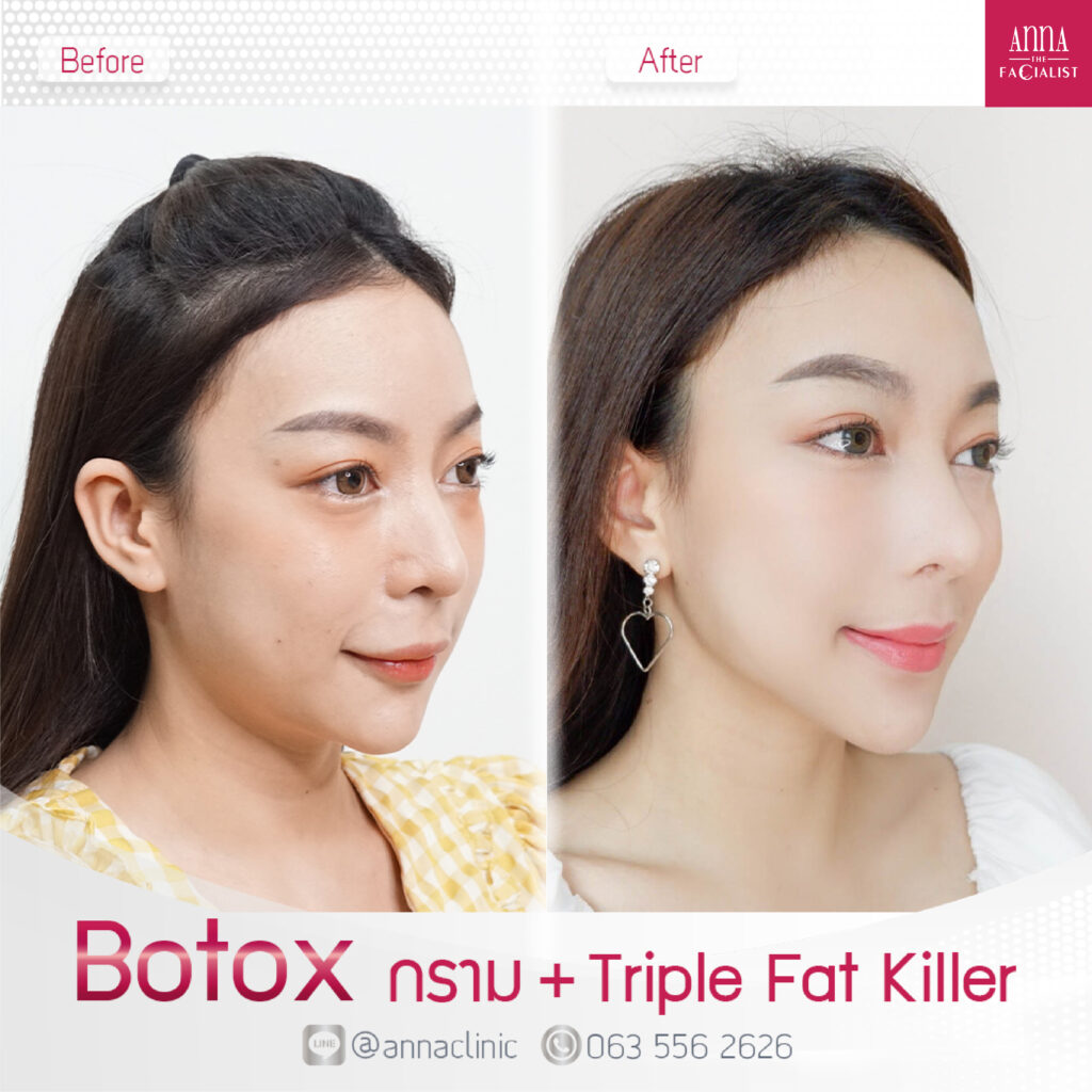 Botox 22 1 scaled
