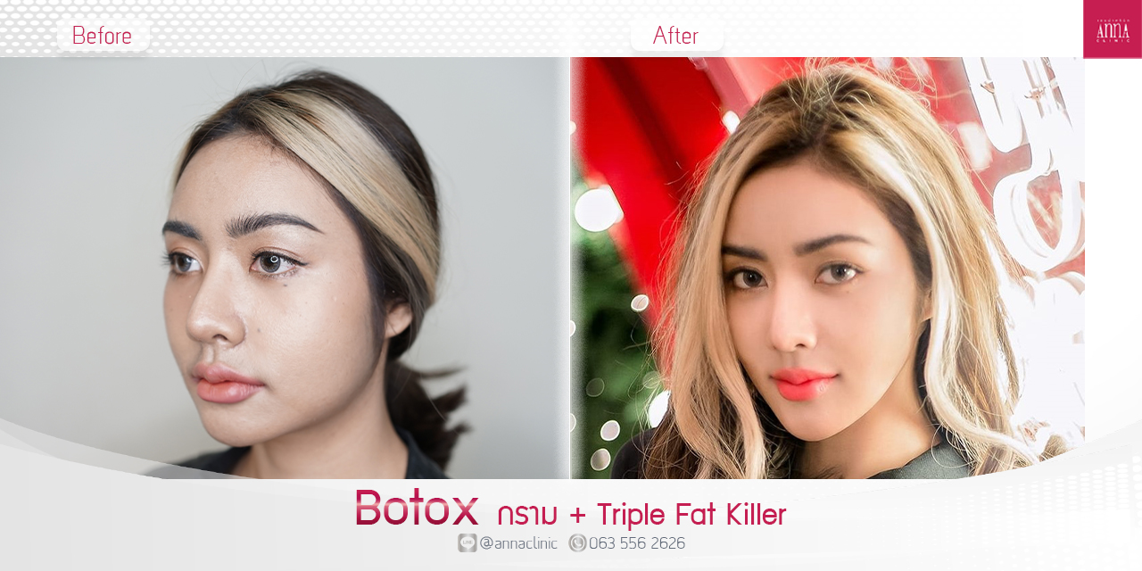 K.บลู Botox กราม2