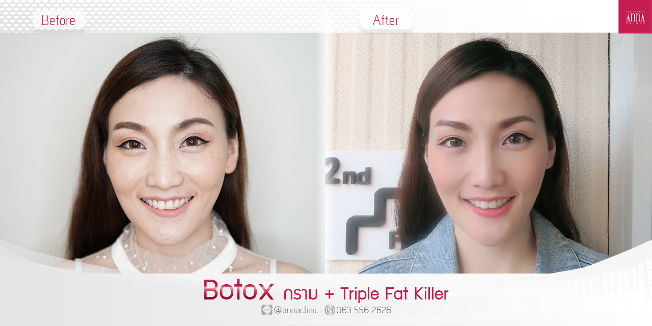 K.บุ๊ค Botox กราม