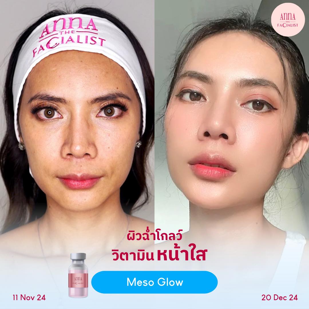 Meso glow รีวิว 1