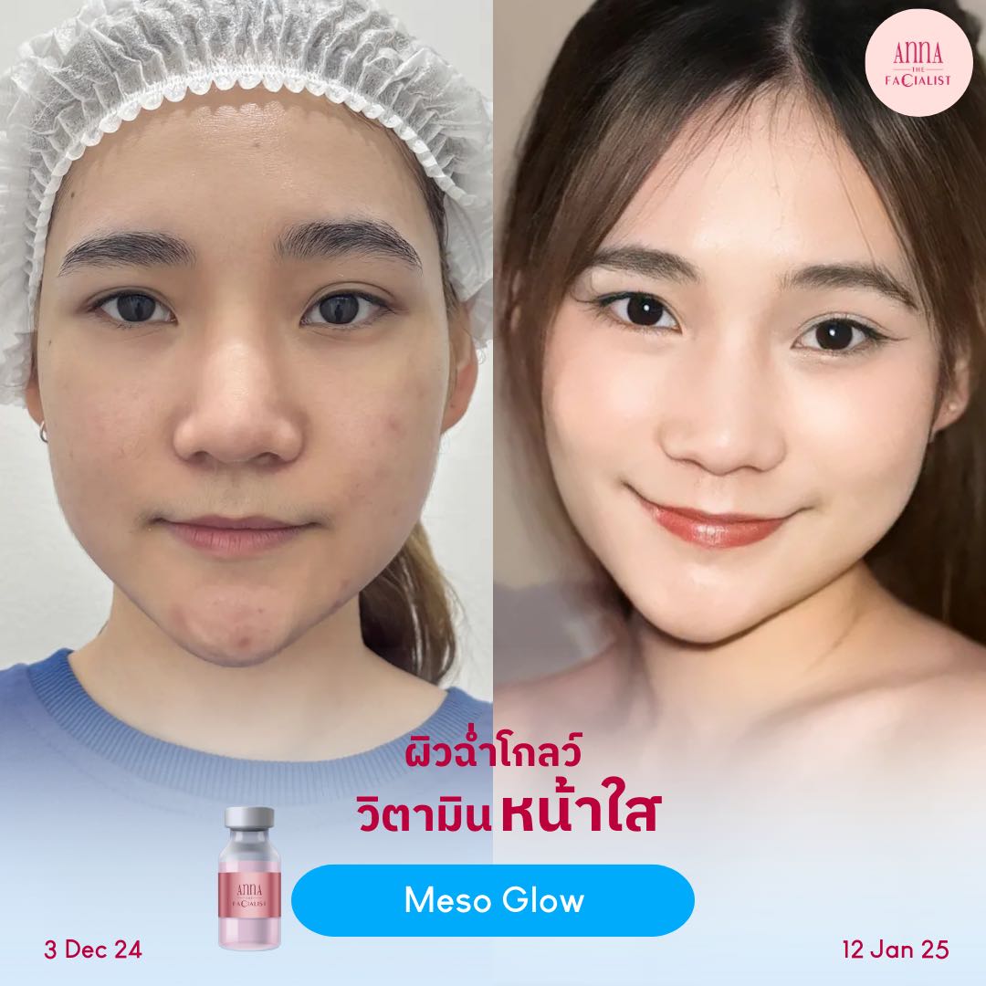 Meso glow รีวิว 3