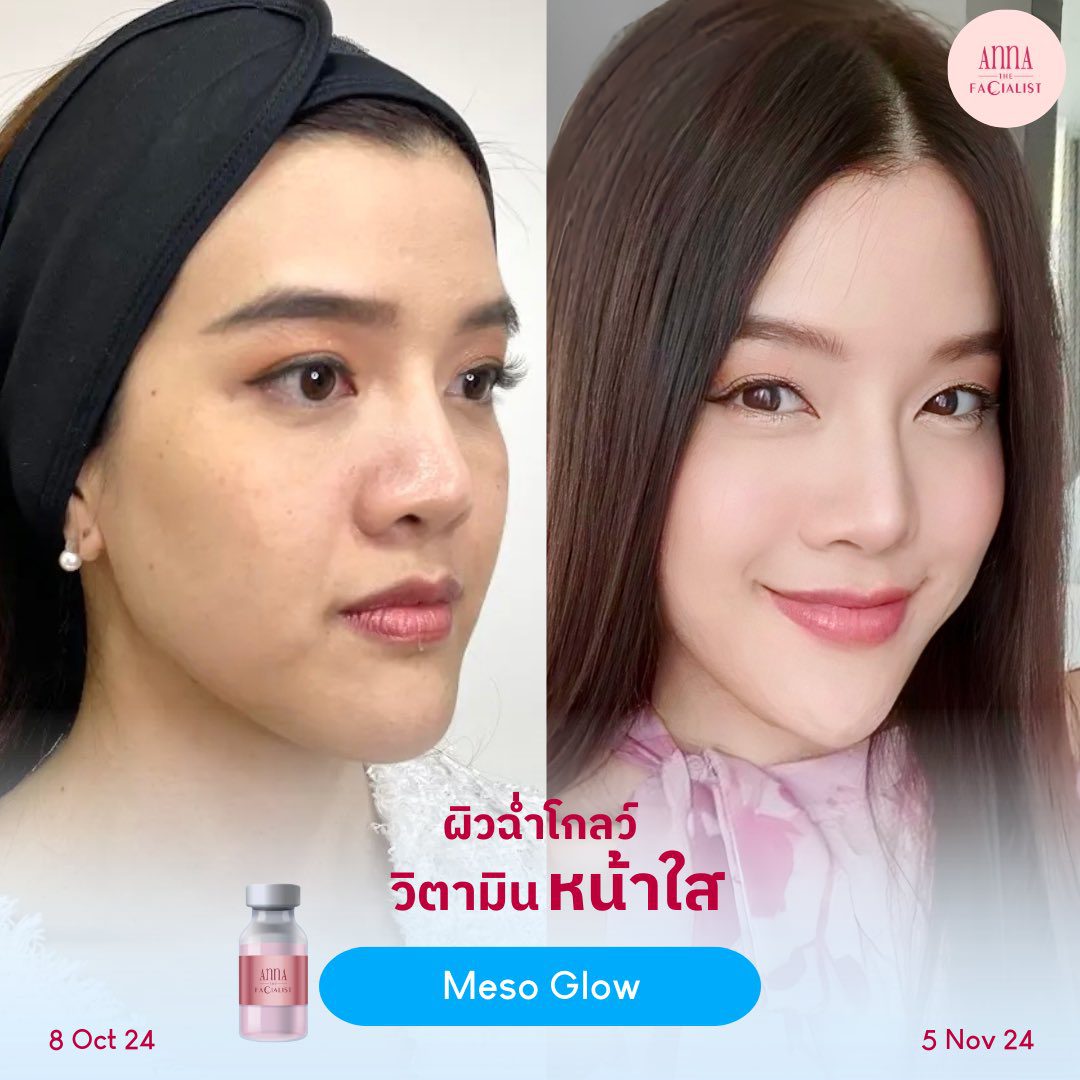 Meso glow รีวิว 4