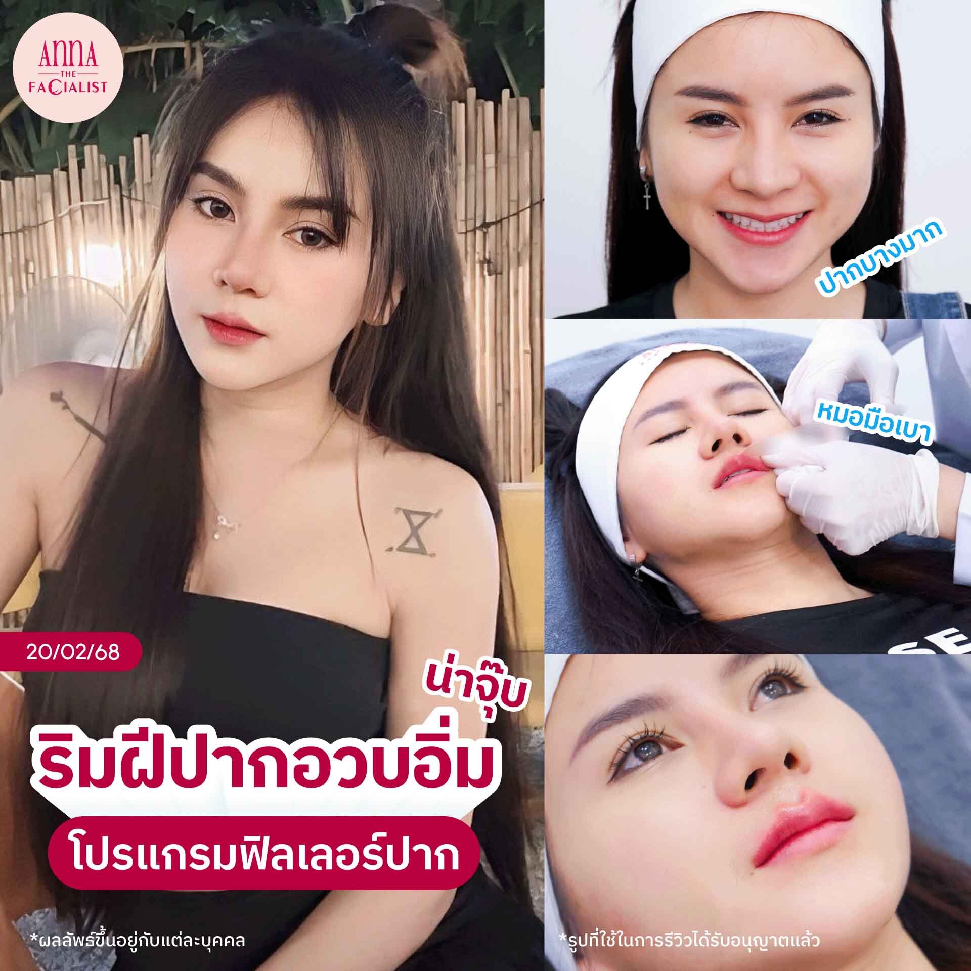 Neuramis ฟิลเลอร์ปาก แอร์ พรสวรรค์