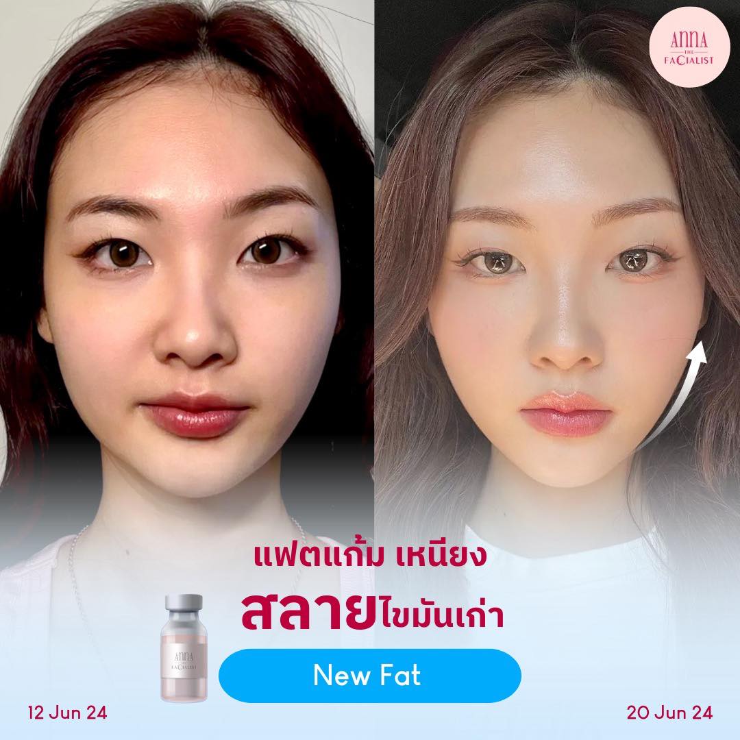 New fat ลดไขมันแก้ม เหนียง 5