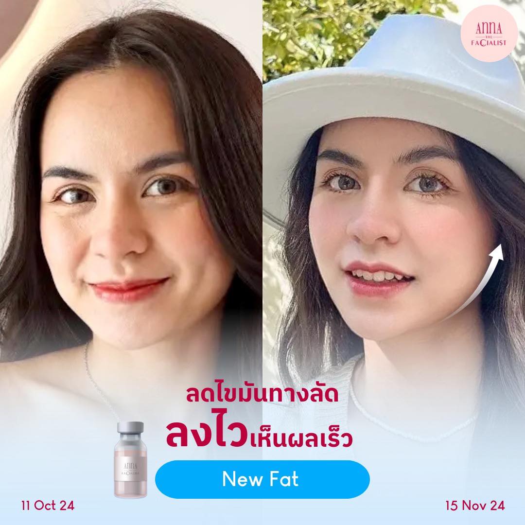 New fat ลดไขมันแก้ม เหนียง 6