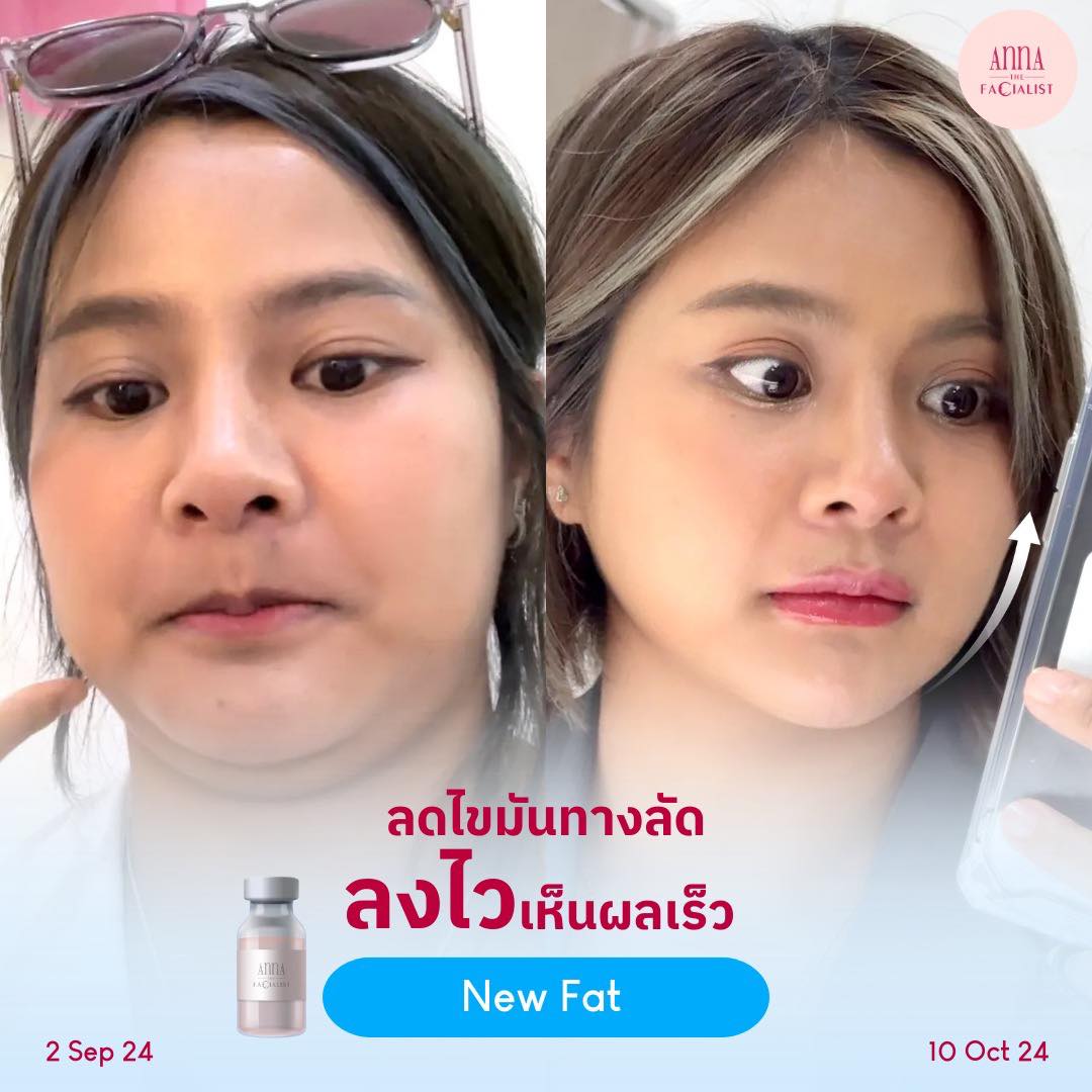New fat ลดไขมันแก้ม เหนียง 8