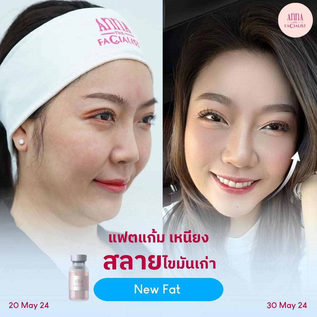 New fat ลดไขมันแก้ม เหนียง 7