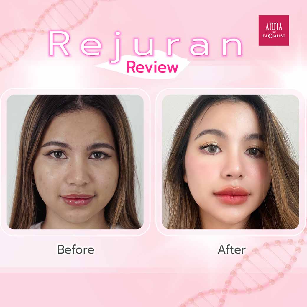 Rejuran Anna Clinic