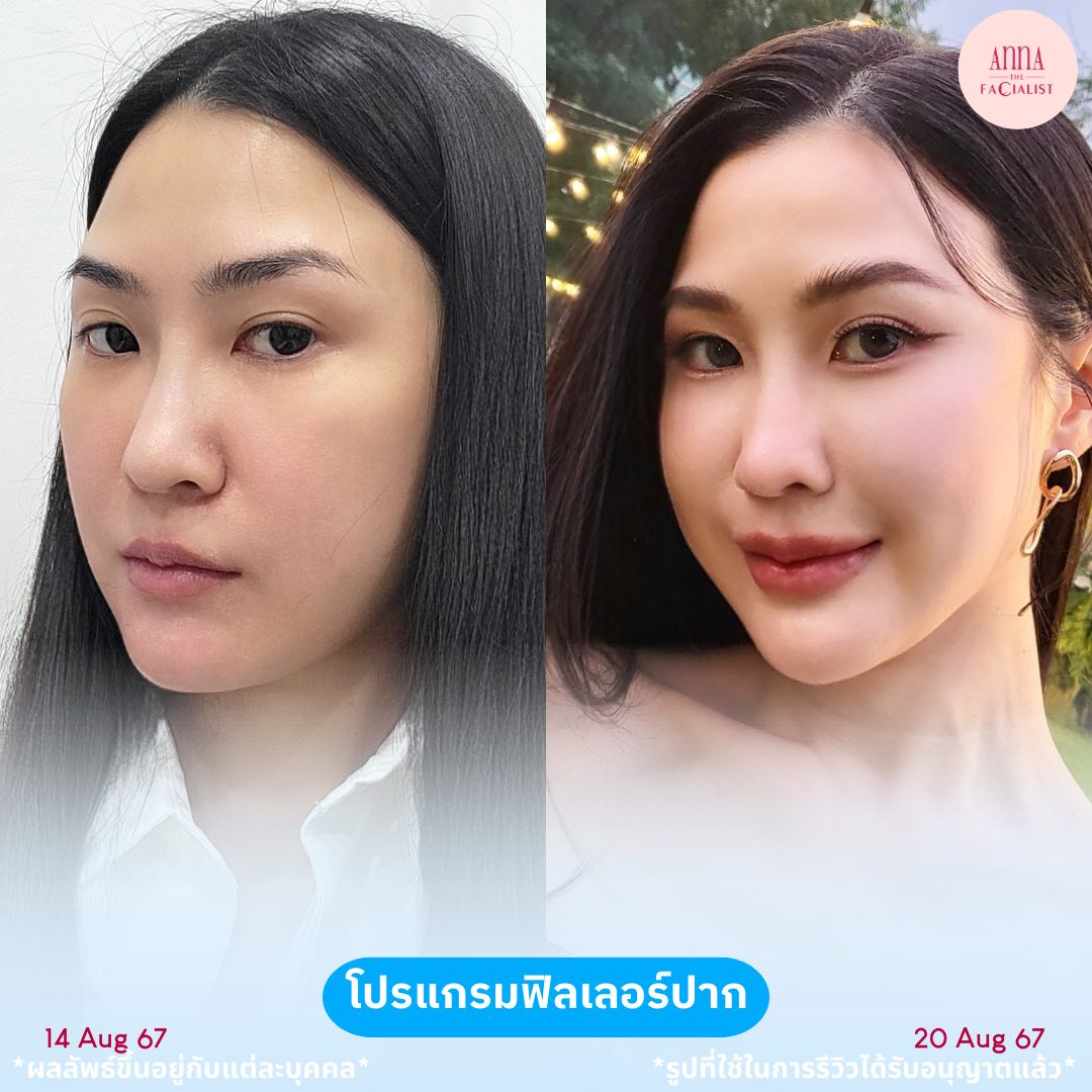 filler ปาก 1