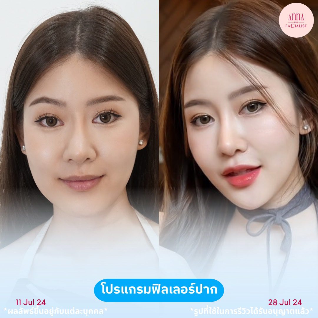 filler ปาก 2