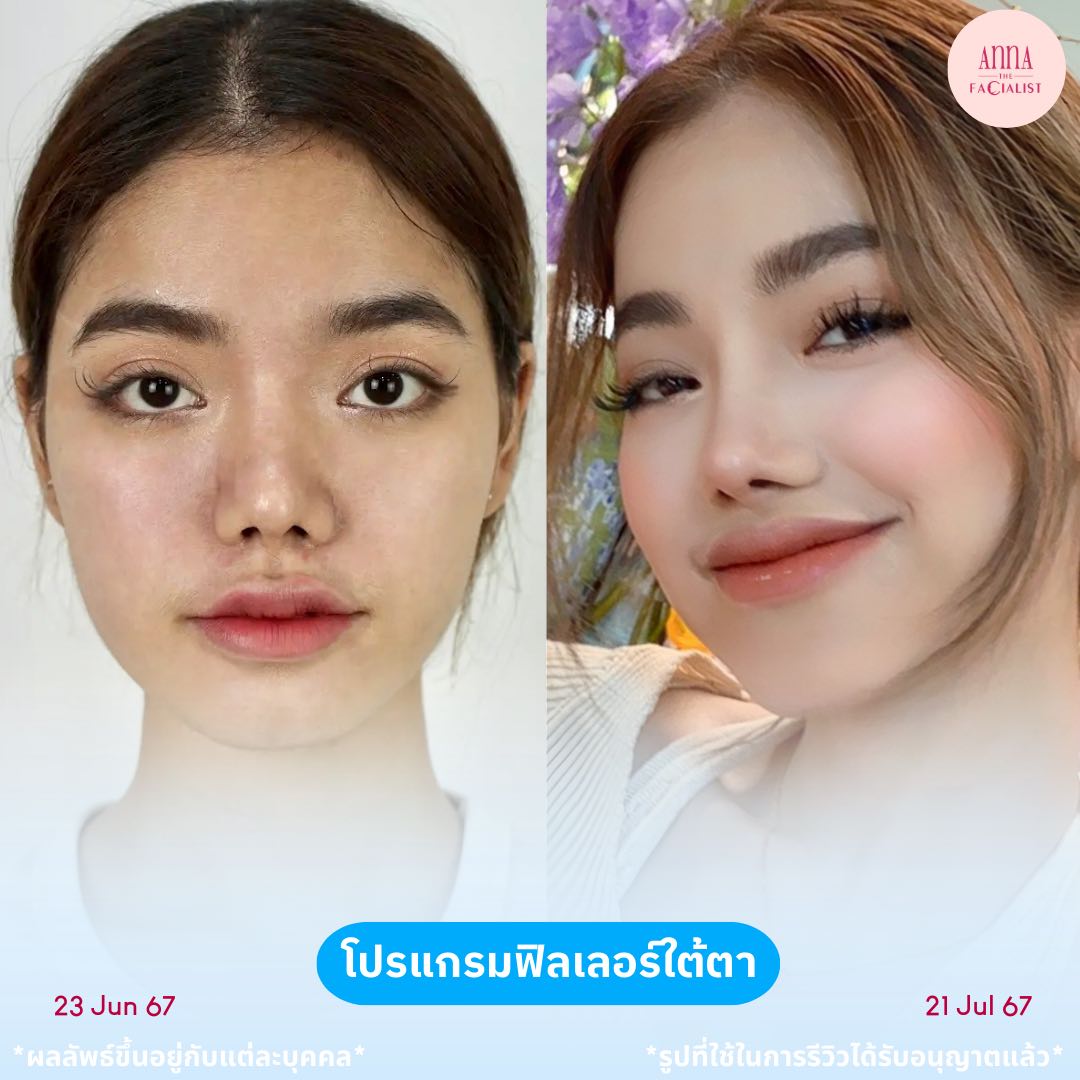 filler ใต้ตา 1