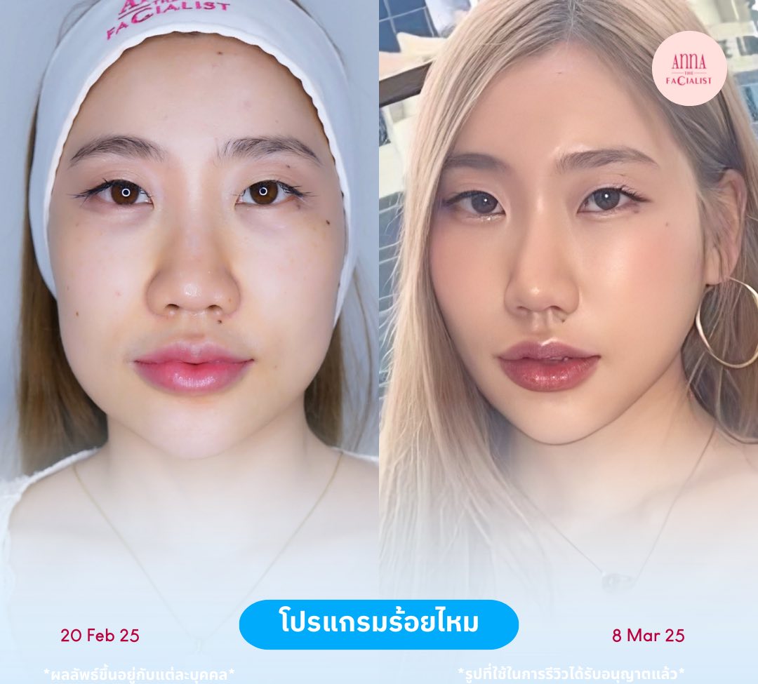 ร้อยไหม 1
