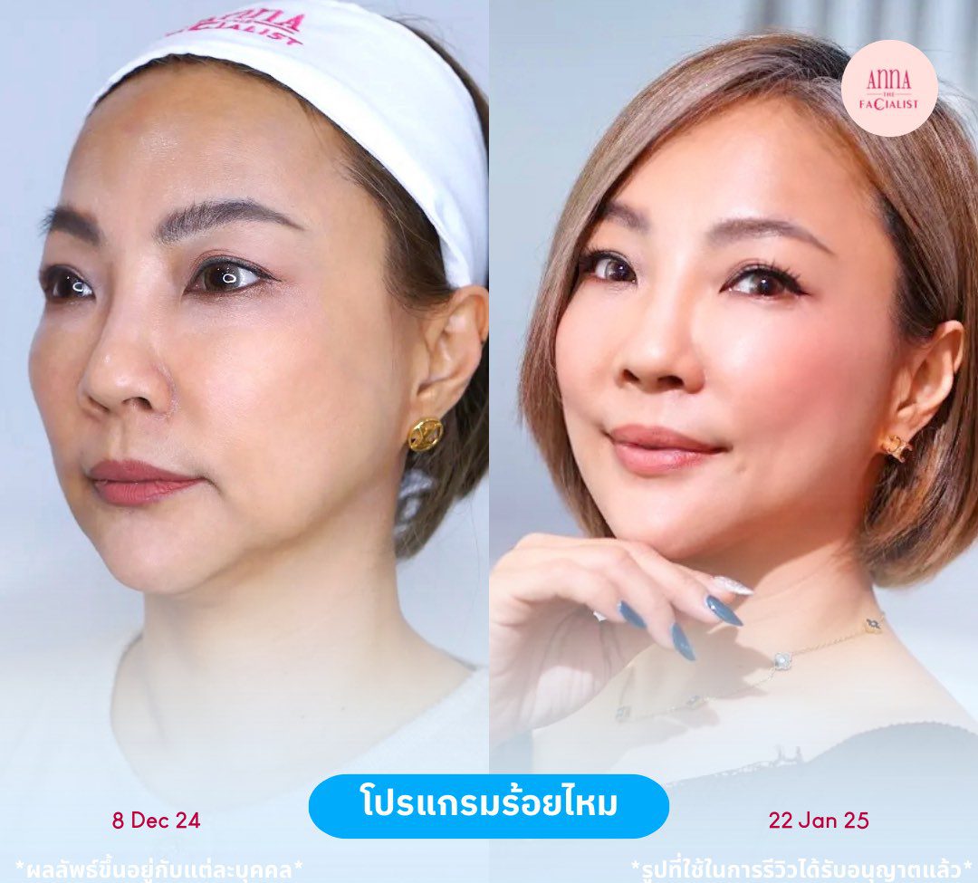 ร้อยไหม 3