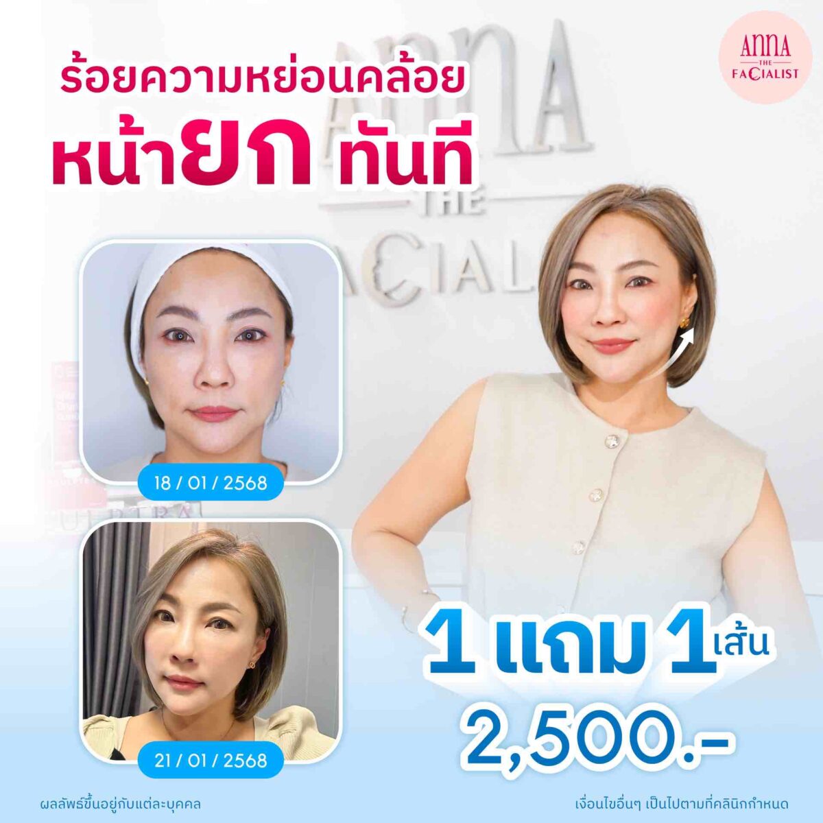 ร้อยความหย่อนคล้อย anna clinic