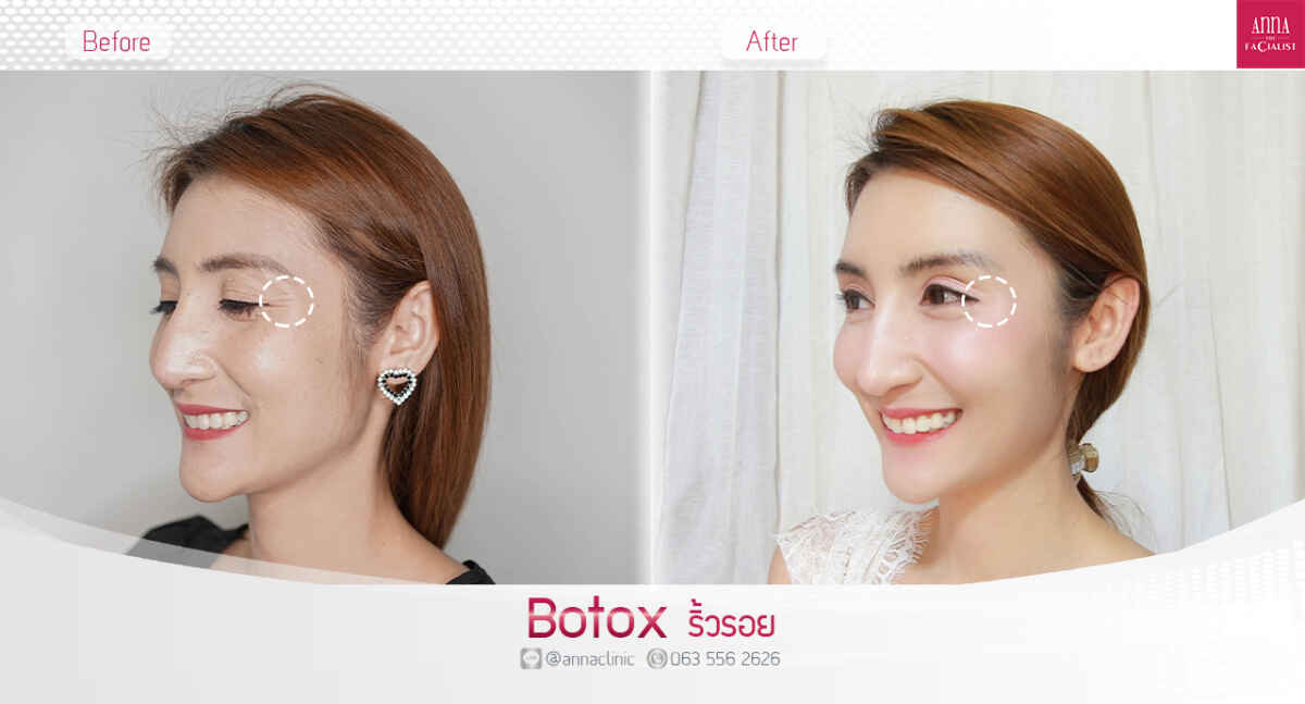 K.ปลา Botox ริ้วรอย Newweb