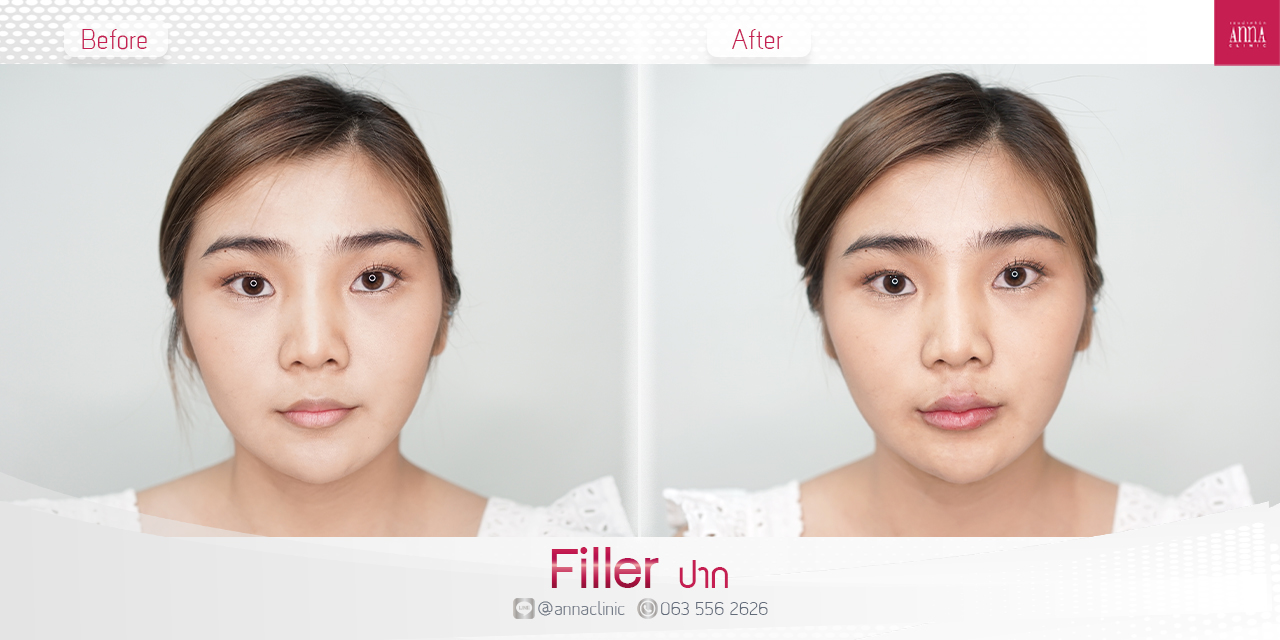K.พะแพง Filler ปาก