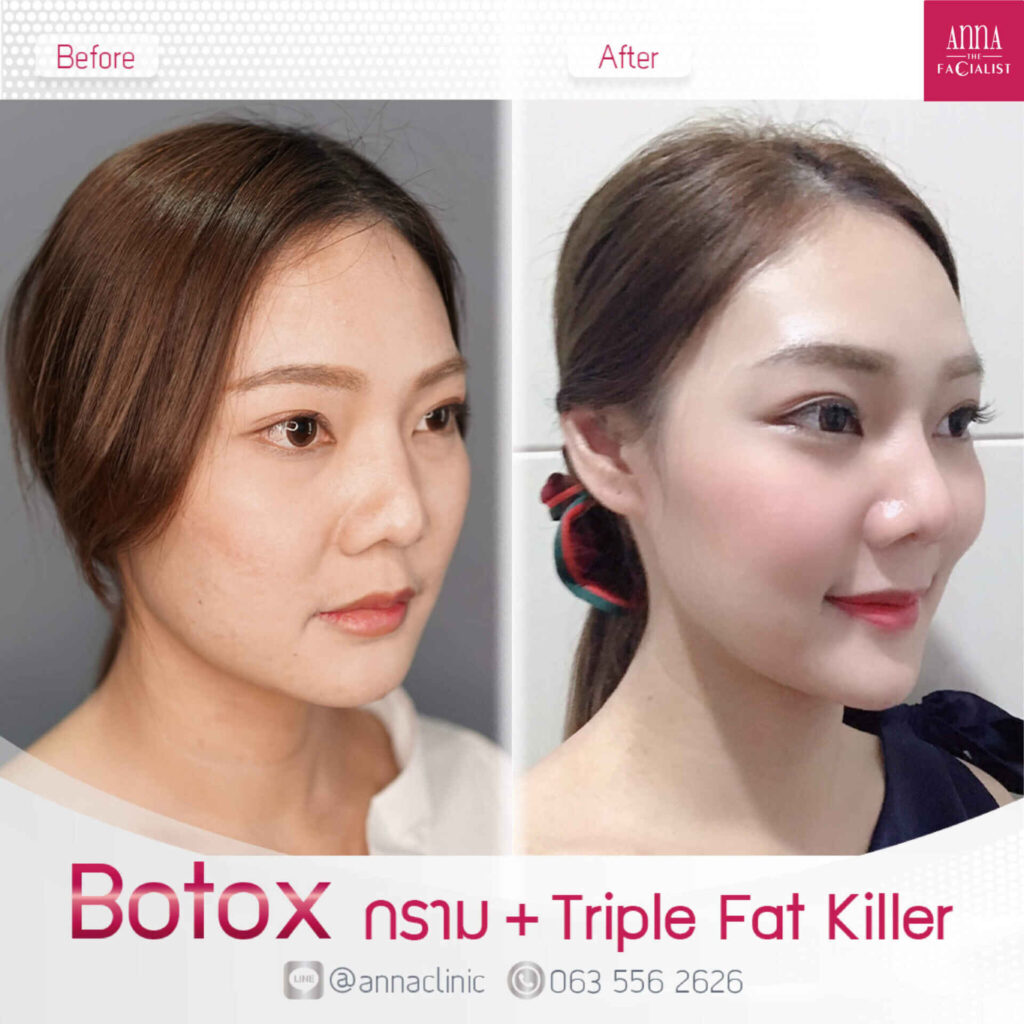 จะฉีดโบท็อกลดกรามทั้งที เลือกอย่างไรดีให้เห็นผลและปลอดภัย