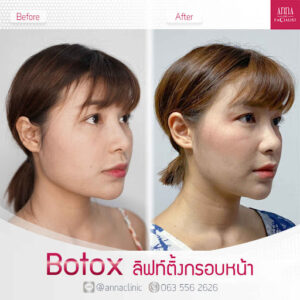 ไม่ต้องพึ่งมีดหมอก็หน้าเรียวเหมือนเซเลบได้ ด้วยการปรับรูปหน้า!