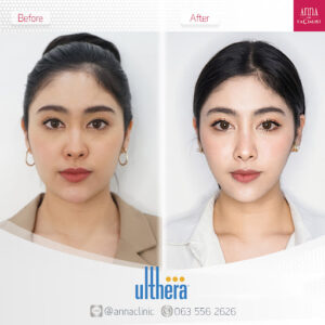 ไม่ต้องพึ่งมีดหมอก็หน้าเรียวเหมือนเซเลบได้ ด้วยการปรับรูปหน้า!