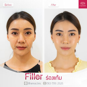 ฟิลเลอร์ราคาเท่าไหร่ เลือกยี่ห้อไหนดี? ตอบทุกเรื่องฟิลเลอร์ที่คุณควรรู้!