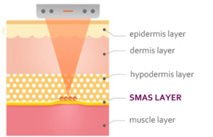 ชวนสาวๆ มายกกระชับหน้าด้วยอัลเทอร่า พร้อมบอกลิสต์ข้อดีข้อเสีย!