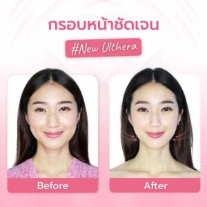 ชวนสาวๆ มายกกระชับหน้าด้วยอัลเทอร่า พร้อมบอกลิสต์ข้อดีข้อเสีย!