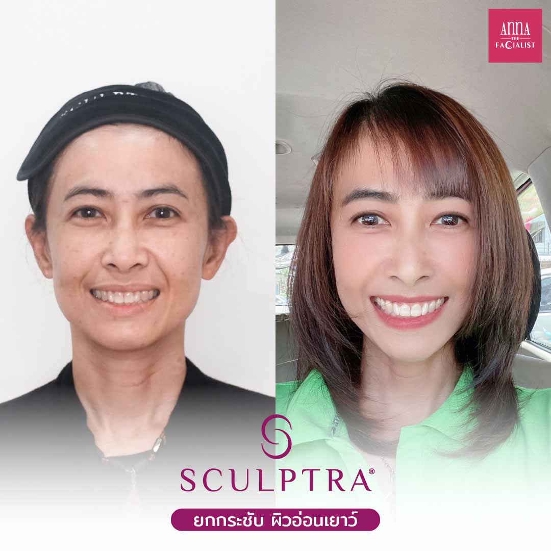 รีวิวฉีด Sculptra 2