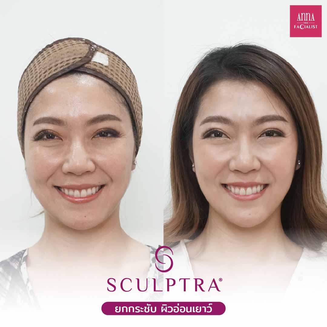 Sculptra รีวิว3