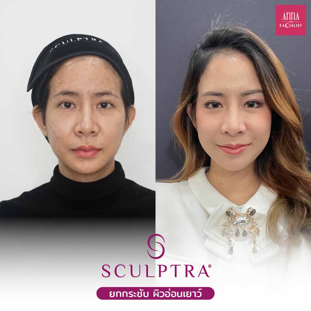 Sculptra รีวิว4