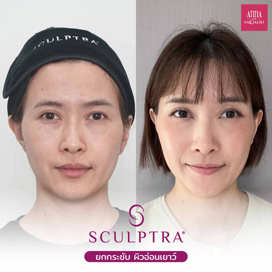 Sculptra รีวิว1