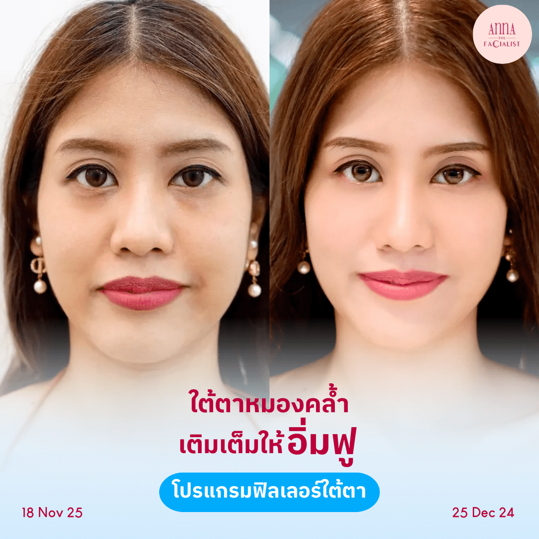 Filler anna clinic5