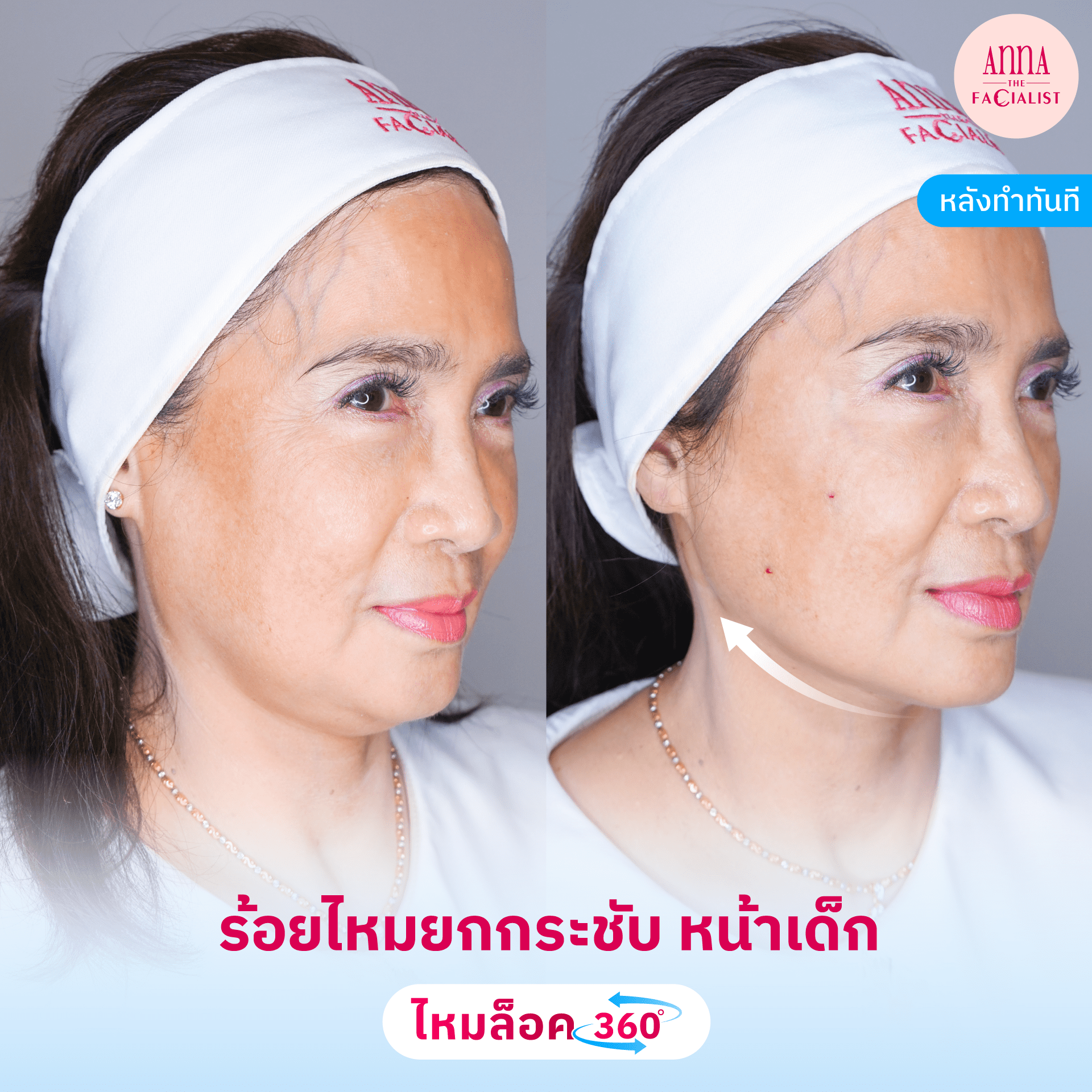 BF AT ไหมล็อค360.4